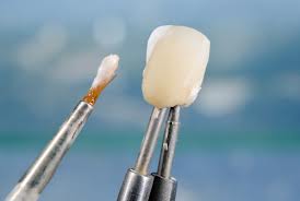 Bonding Resin applied to chipped tooth.