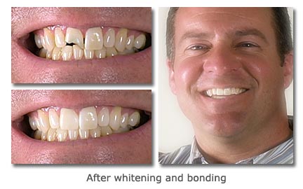 dental bonding - before and after images