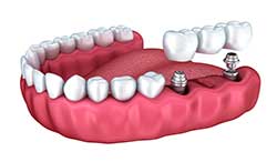 replacing multiple missing teeth with dental implants