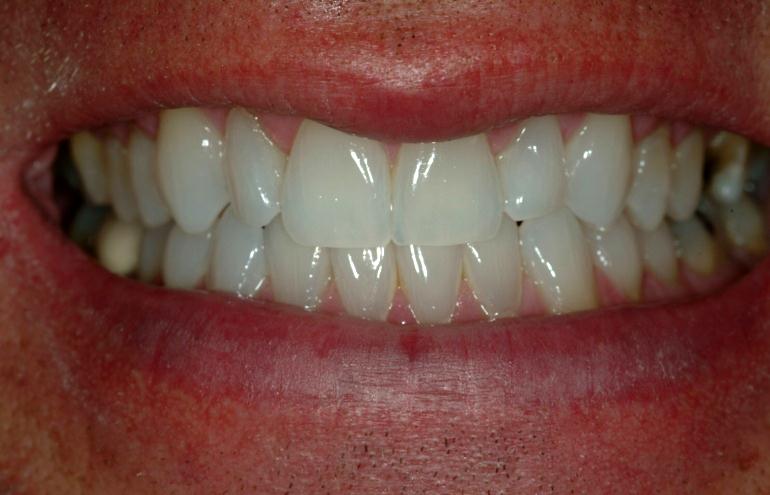 Invisalign after smile