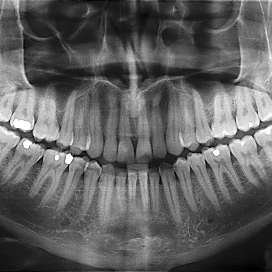 Teeth on the X-ray