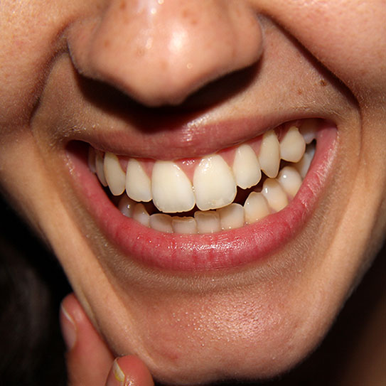 Closeup of white spots on teeth