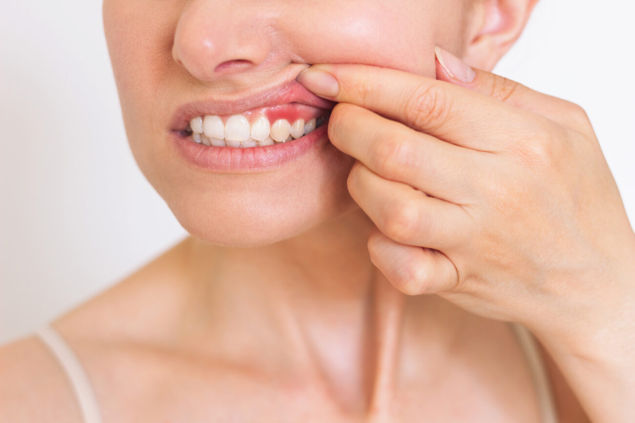 Young woman showing inflamed red gums on her upper jaw