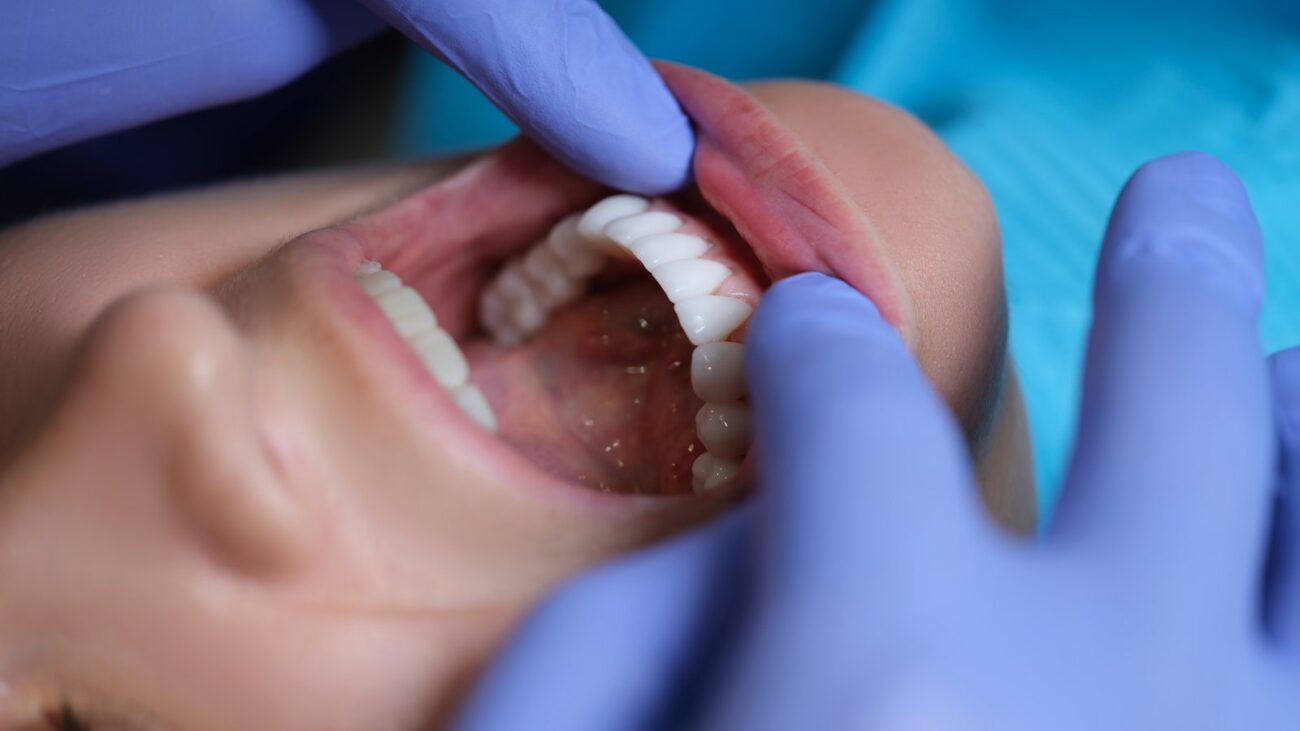 Dentist examining a patient's oral cavity for signs of tooth decay