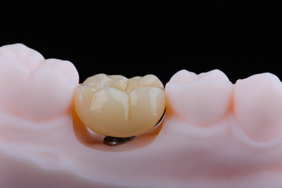 Two dental crowns made of zirconium on titanium abutments for fixation to implant on lower jaw. Teeth treatment and implantation.