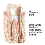 RootCanal_3