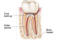 RootCanal_4