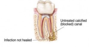 RootCanal_5