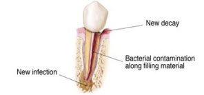 RootCanal_6
