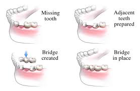 Dental bridge process