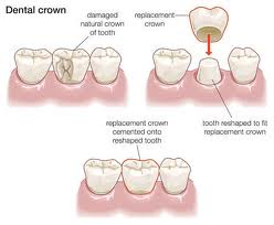 Creating a dental crown - diagram of process