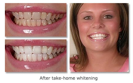 after take-home whitening