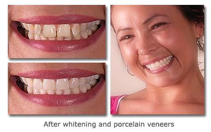 Porcelain veneers can transform your smile