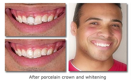after porcelain crown and whitening 